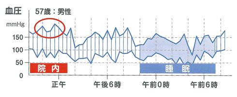 白衣高血圧 画像