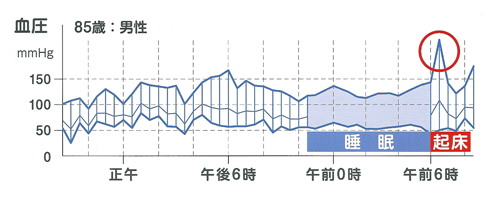 早朝高血圧 画像