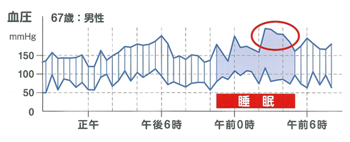 夜間高血圧 画像